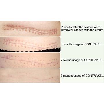 Photo scar